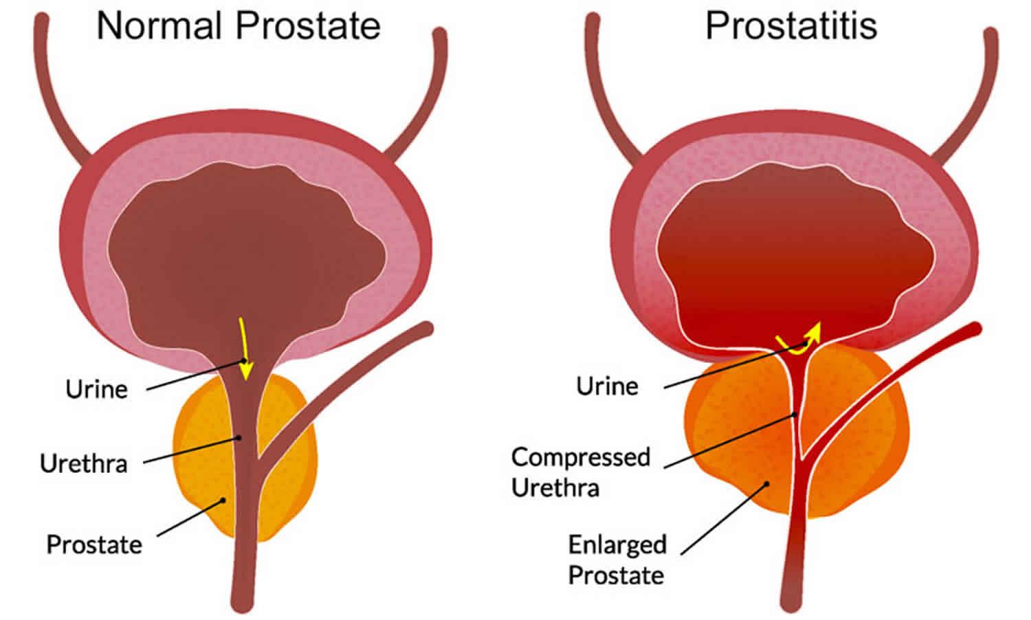 PROSTATITIS SYMPTOMS: Natural plant-based treatment