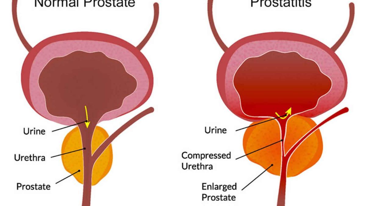 PROSTATITIS SYMPTOMS: Natural plant-based treatment