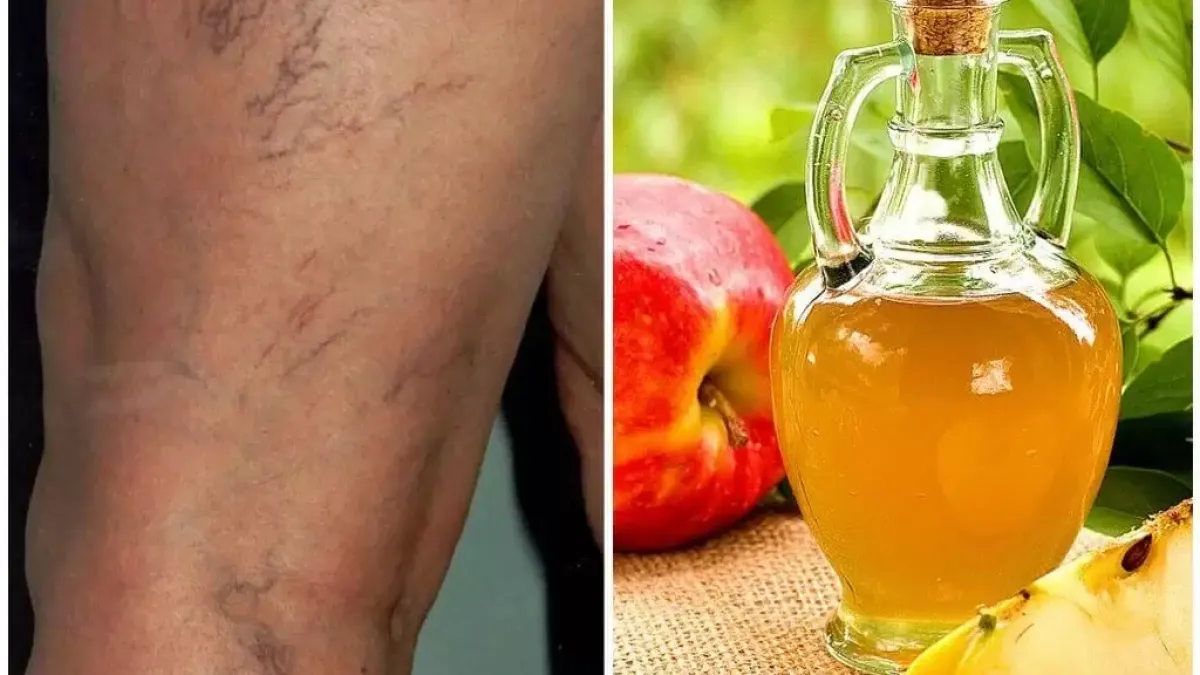 remedio natural para la insuficiencia venosa