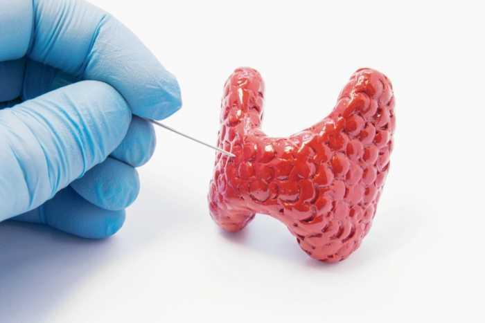 HYPOTHYROÏDIE: nutrition et régime