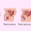 Sterilite homme