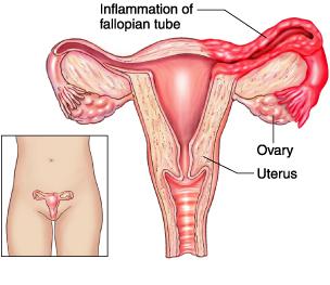 SALPINGITIS NATURAL TREATMENT