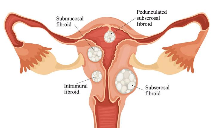7 ways to naturally get rid of fibroids and ovarian cysts