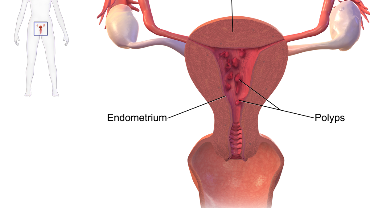 SYMPTOMS OF UTERINE POLYPs: Natural treatment
