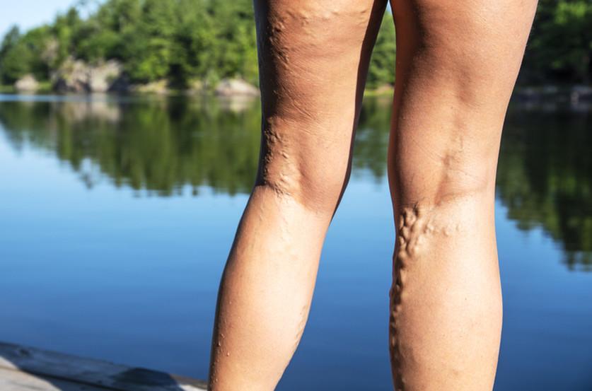 Varices w837 h553 r4 q90