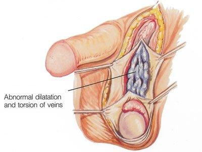 HERBAL TREATMENT AGAINST VARICOCELE: Dawasanté Experts