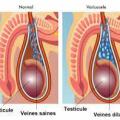 Varicocele 1