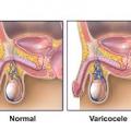 Varicocele apres chirurgie