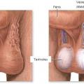 Varicocele douleurs 1